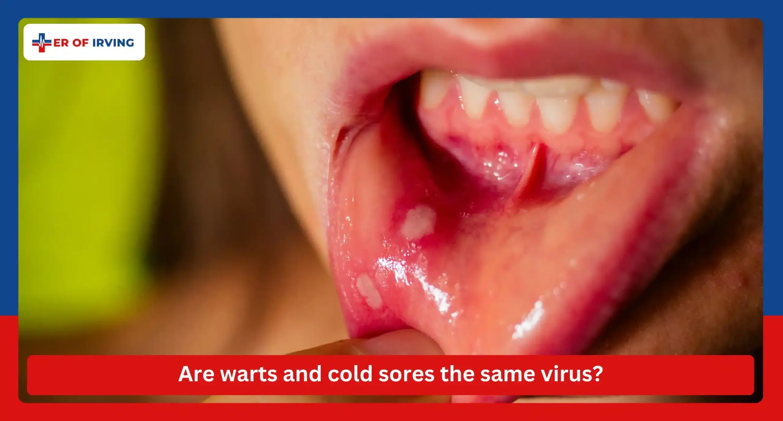 Are warts and cold sores the same virus