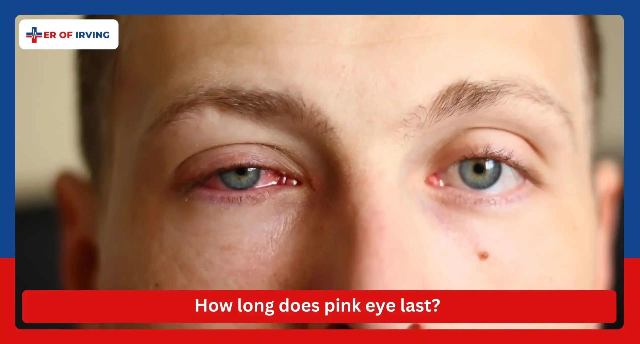 How do I know if I have pink eye, and is pink eye contagious? 2 How do I know if I have pink eye, and is pink eye contagious? How long does pink eye last