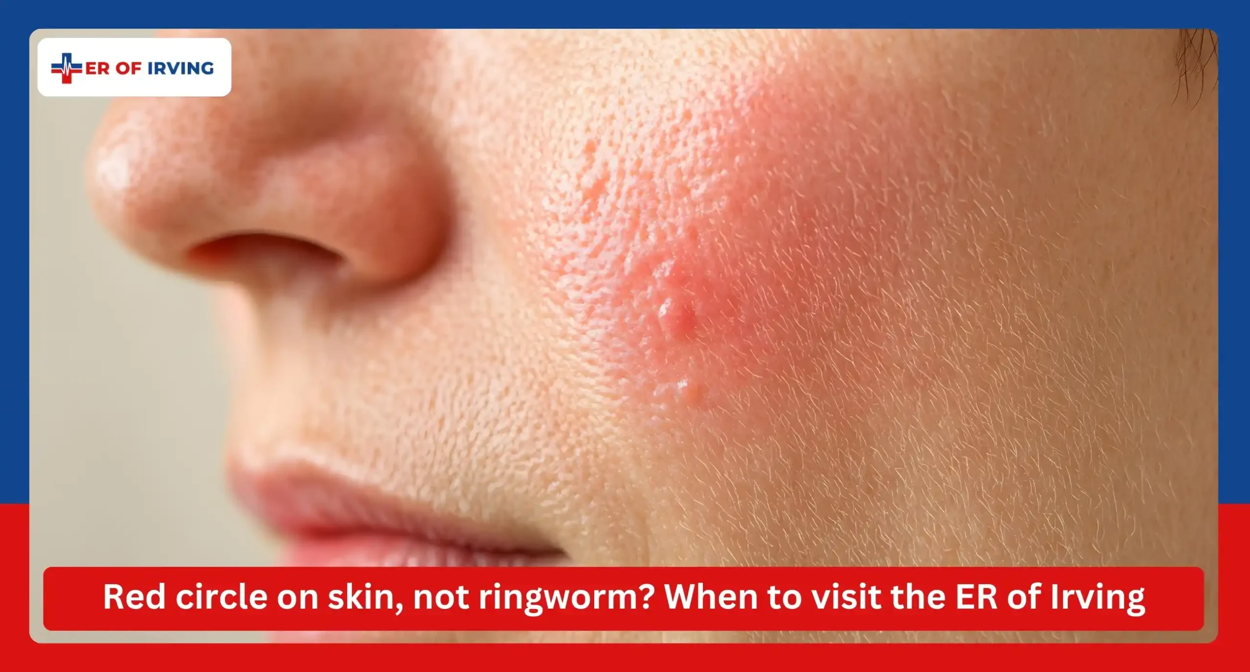 Red circle on skin, not ringworm