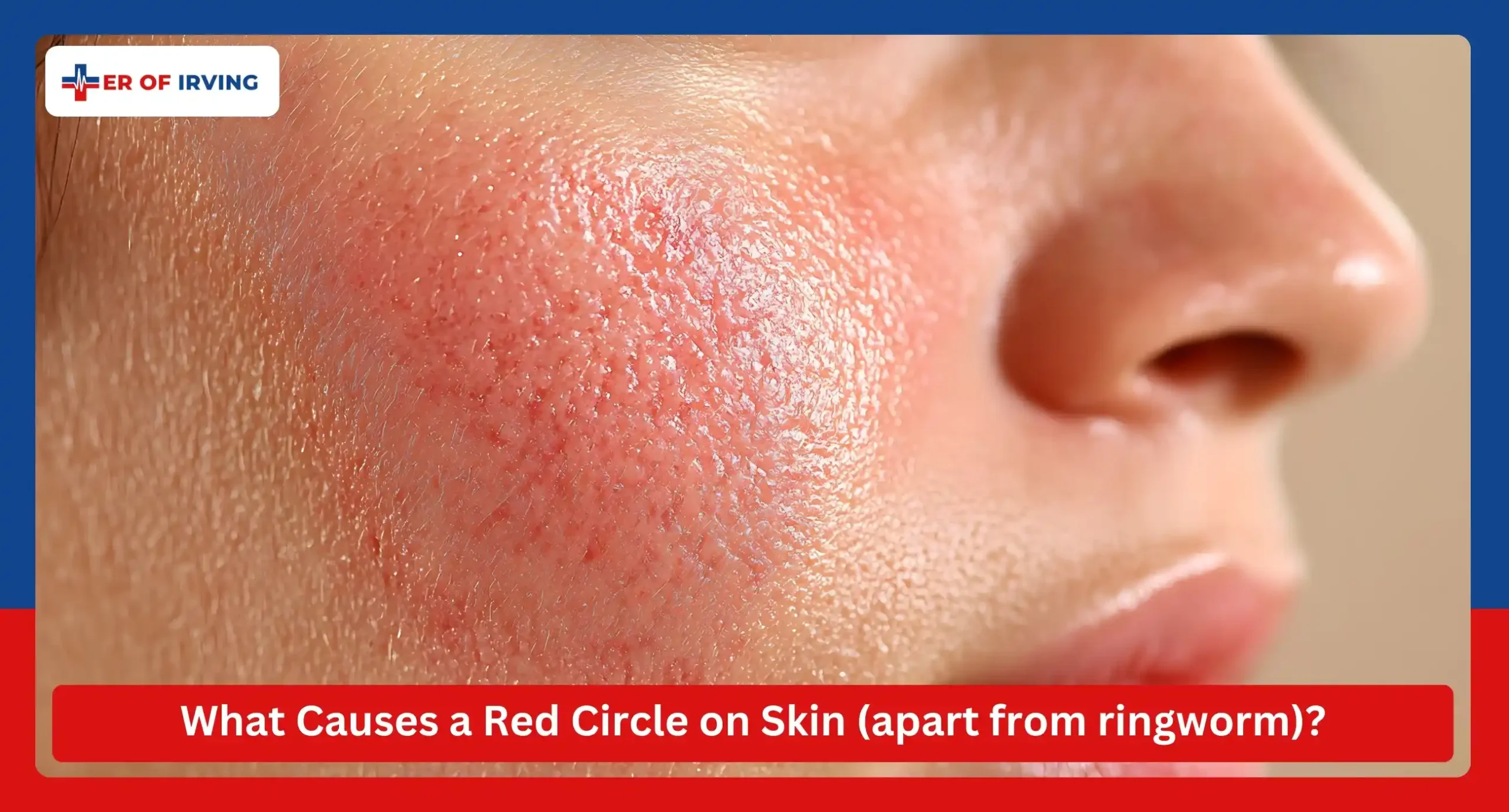 Red circle on skin, not ringworm? Here’s when to visit the ER of Irving 1 Red circle on skin, not ringworm? Here’s when to visit the ER of Irving What Causes a Red Circle on Skin (apart from ringworm)