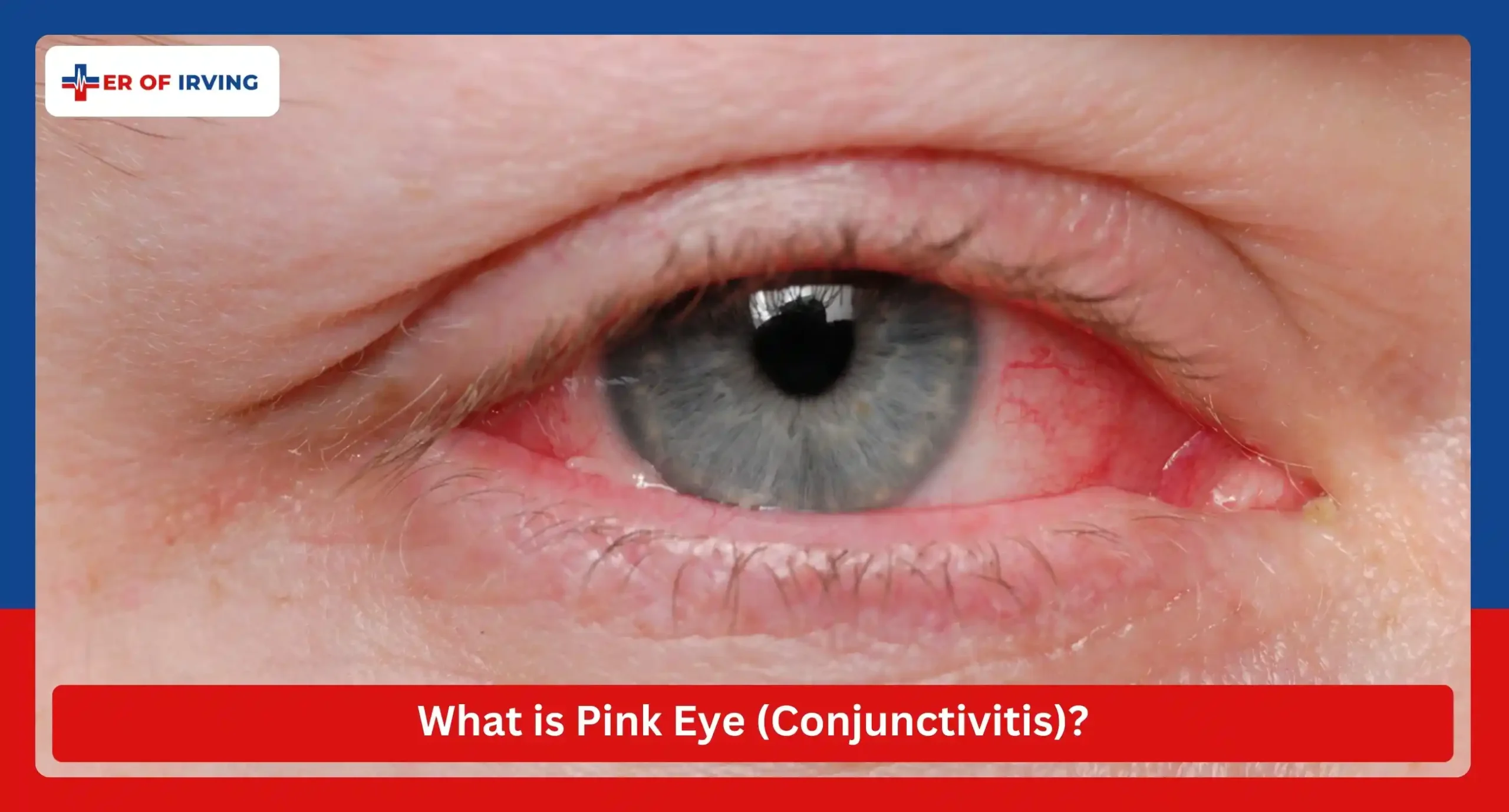How do I know if I have pink eye, and is pink eye contagious? 1 How do I know if I have pink eye, and is pink eye contagious? What is Pink Eye (Conjunctivitis)